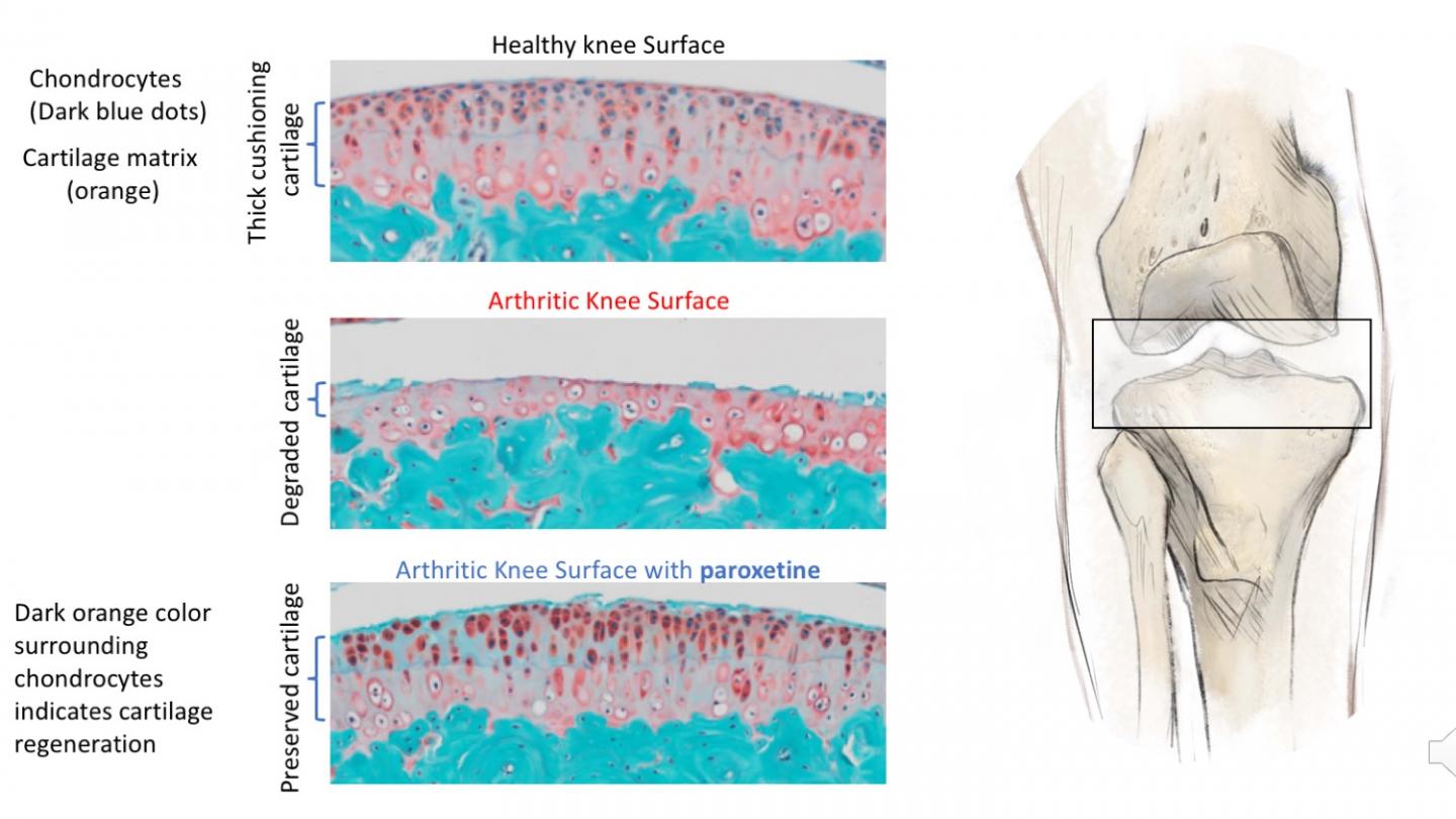 Osteoarthritis treatment with paroxetine