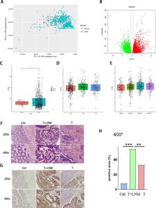 Expression of PFDN6 in patients with CRC.