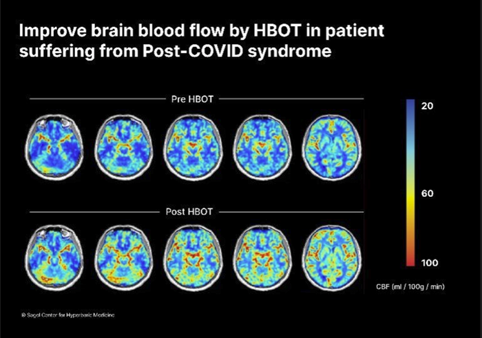 Improved cerebral blood flow by HBOT in patient suffering from post-COVID symptoms.