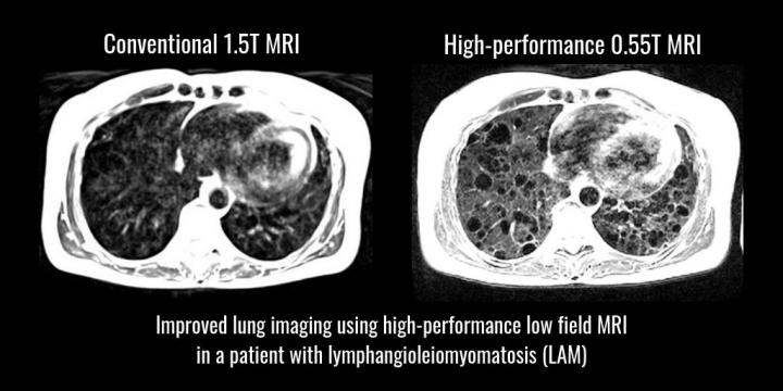Conventional vs Low Field MRI of Lung