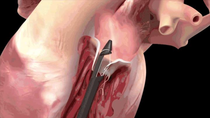 Minimally Invasive Procedure Increases Options for Mitral Valve Repair