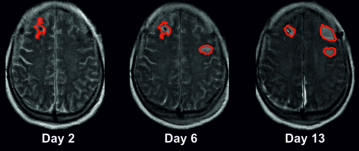 MRI images after a subarachnoid hemorrhage