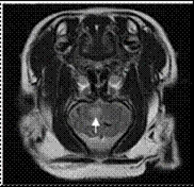 MRI Evidence of Infarction Foci