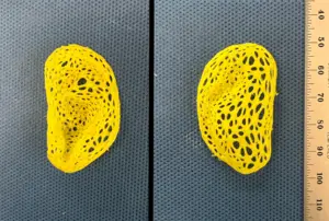 Pictured is the intricate, left-ear plastic scaffold that was created on a 3D printer based on data from a person’s ear, anterior view (left) and posterior view (right).