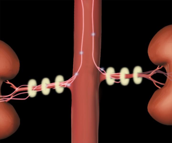 Renal Denervation System 3