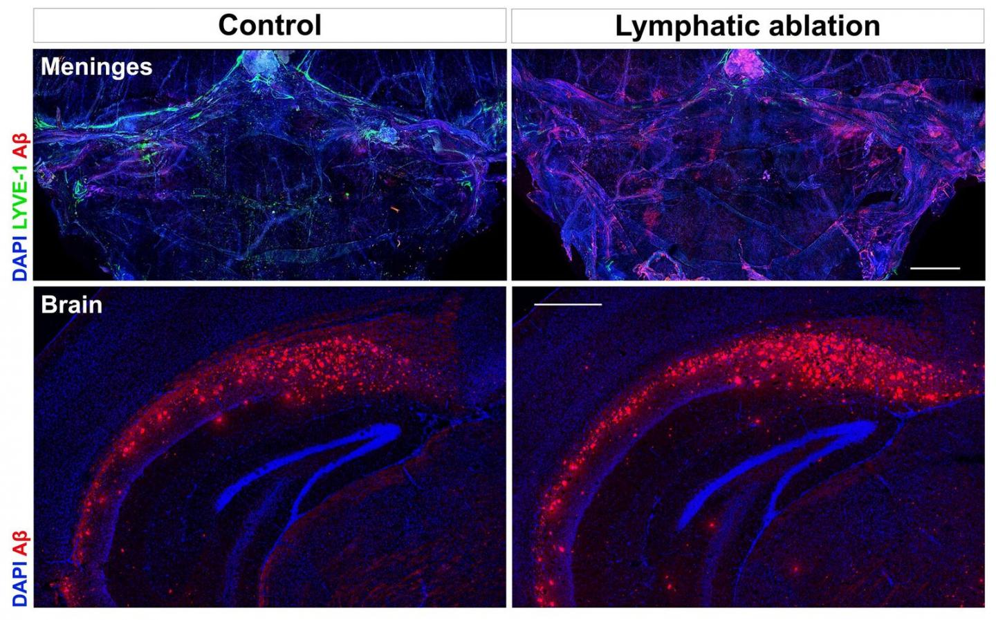 Faulty Brain Plumbing to Blame in Alzheimer's, Mental Decline with Age -- and Can Be Fixed