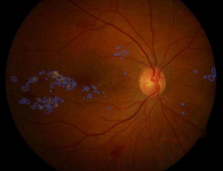 Damaged Retina