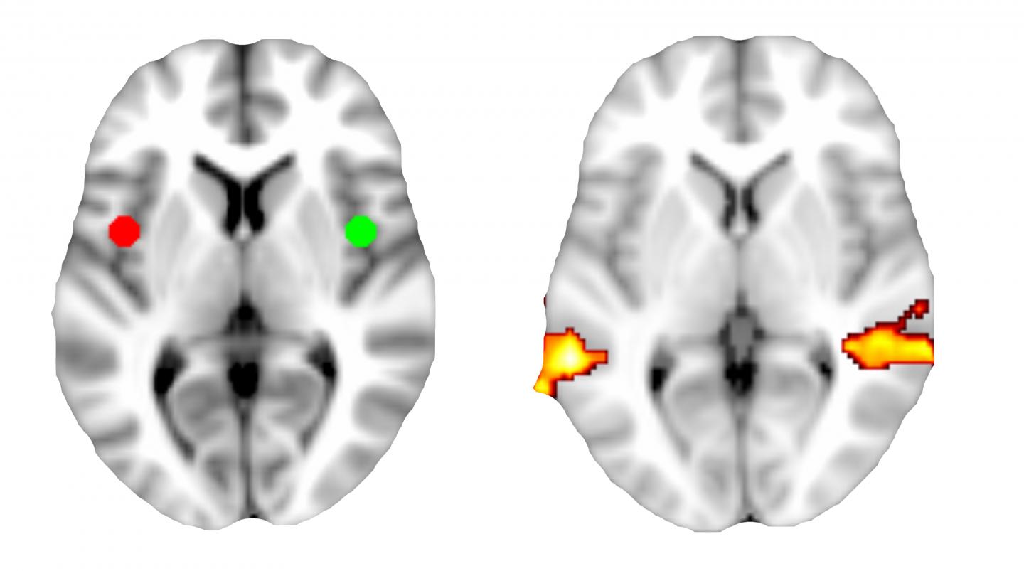 brain scan depression