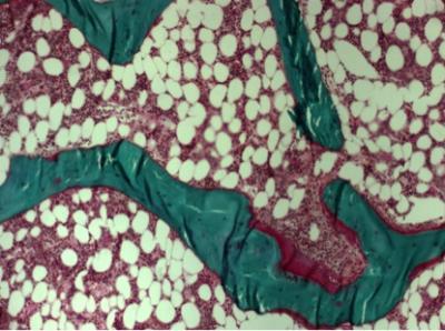 Bone Biopsy (2 of 2)