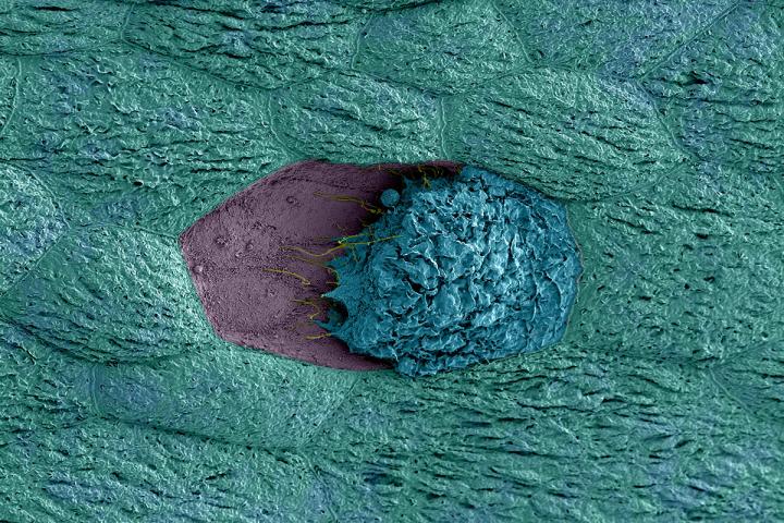 Vaginal Bacteria Trigger Recurrent UTI