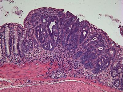 Colon Tumor