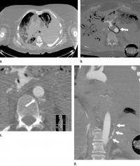 Postmortem CT and Arterial Phase Postmortem CT Angiography Images