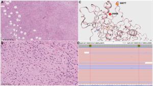 Rapid but nondurable response of a BRAF exon 15 double-mutated spindle cell sarcoma to a combination of BRAF and MEK inhibitors