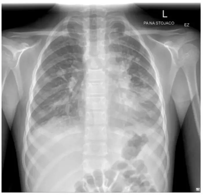 Chest X-ray of Mycoplasma Pneumoniae Infection