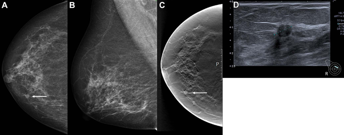 AI Shows Potential in Breast Cancer Screening Programs