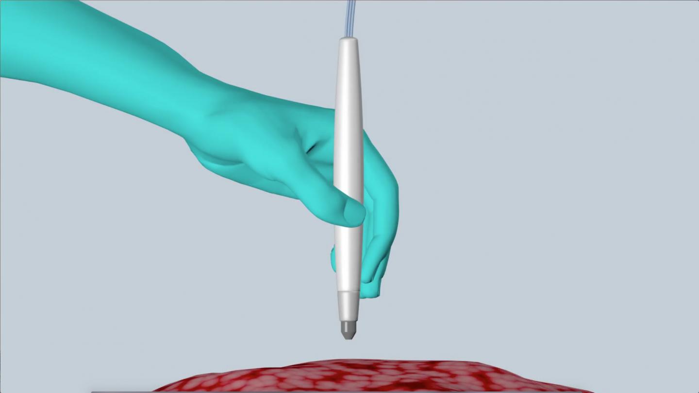 Handheld "Pen" May Bring Real-time Cancer Diagnosis to Surgeons' Fingertips (10 of 11)