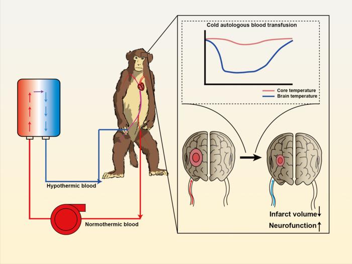 Cold autologous blood transfusion induced rapid temperature reduction in the brain and significantly improved the prognosis of acute ischemic stroke.