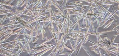 Uric Acid Crystals (1 of 2)