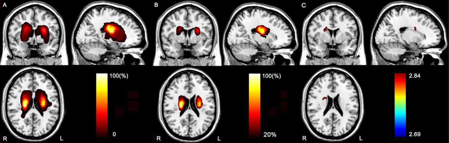 Images of Stroke Lesions (1 of 2)