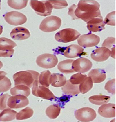 Cells Attacked by Malaria