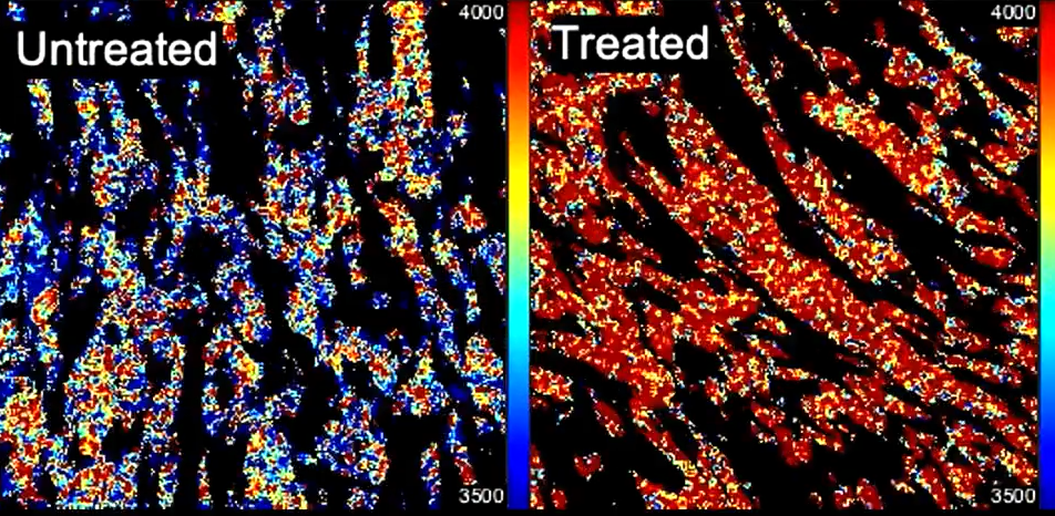 The cancer driver molecule AKT in pancreatic cancer cells