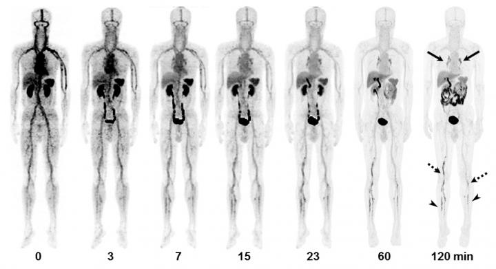 Images of a 55-Year-Old Man with Deep-Vein thrombosis and Pulmonary Embolism