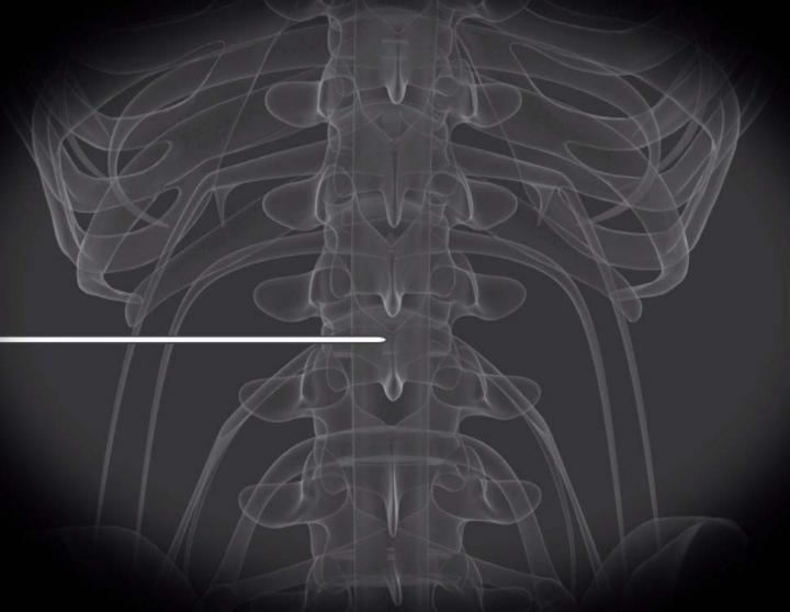 Pulsed Radiofrequency Relieves Acute Back Pain and Sciatica (1 of 2)