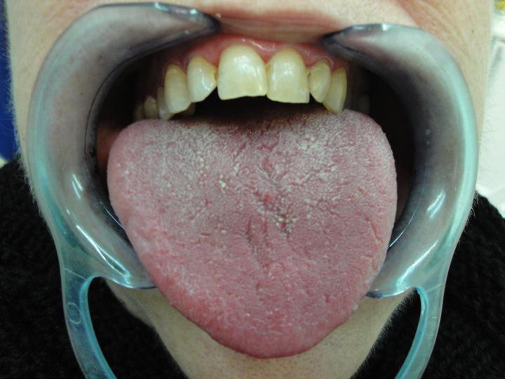 Tongue of a Female Patient Suffering From Xerostomia