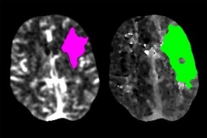 Stroke Neuroimaging