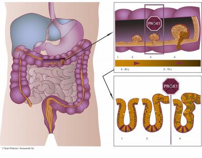 Prox1 Gene Induces Cancerous Growth in Colon Carcinomas