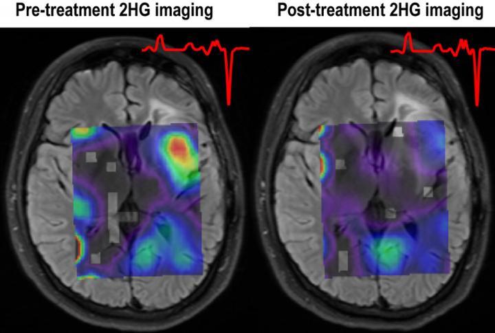 Imaging Reveals Response to Targeted Glioma Treatment