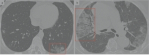 Thoracic CT