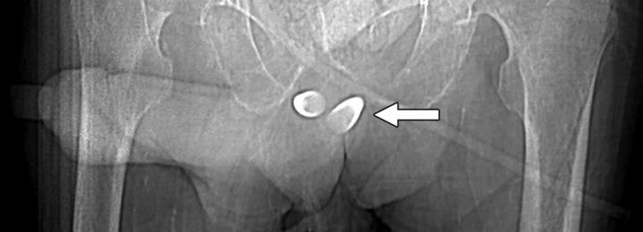 Erectile Prosthesis Variants