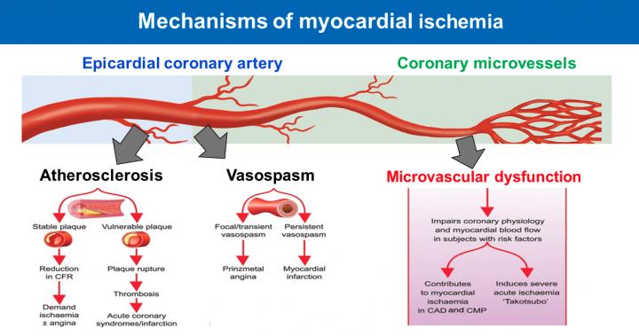 Microvascular angina is important global health problem