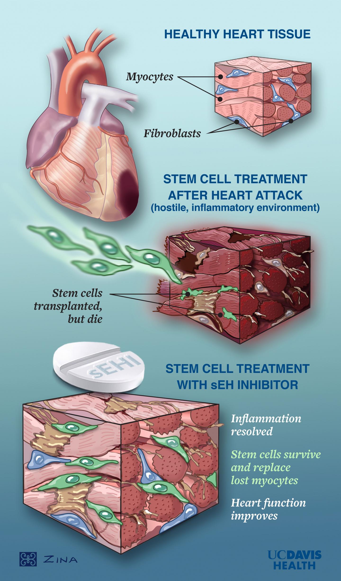 Stem Cell Treatment for Heart Failure Illustration