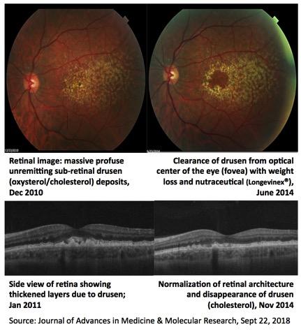 Drusen Clearance Over Time With Diet + Nutraceutical