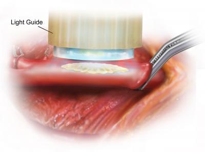 Light-Activated Glue for a Broken Heart (3 of 7)