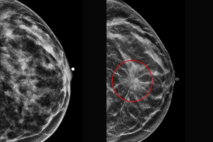 Mammogram of breast pre-cancer and with cancer