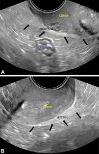 Transvaginal US in normal right and left uterosacral ligaments