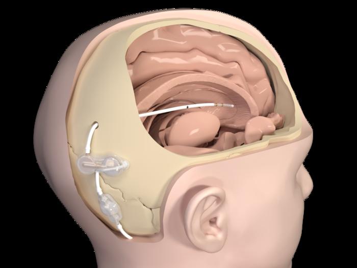 Daily flushing regimen with simple implant ma