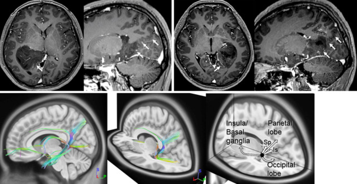 Magnetic resonance images of posterior medial temporal gliomas