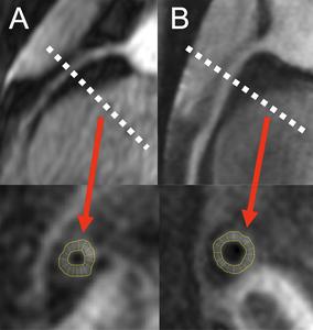 MR angiograms in persons living with HIV.