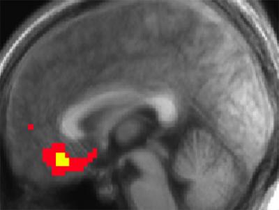 Medial Orbitofrontal Cortex
