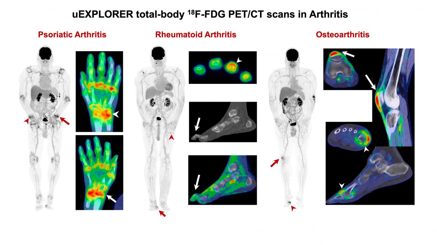 Total Body PET CT IMAGE EurekAlert Science News Releases