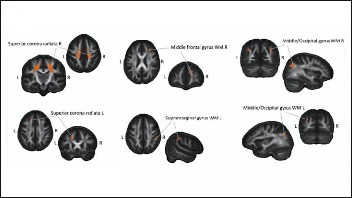 How Learning Braille Changes Brain Structure Over Time