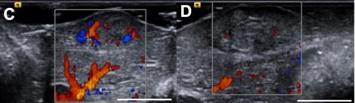 Tumor-Killing Liquid Offers A Safer "Bridge" Therapy for Patients with Liver Cancer (2 of 3)
