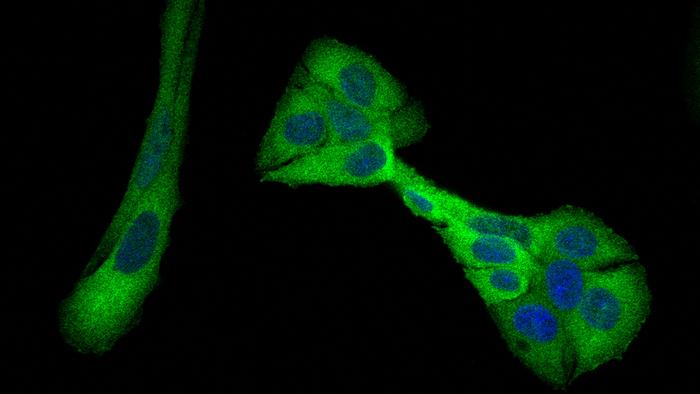 PHGDH in breast cancer