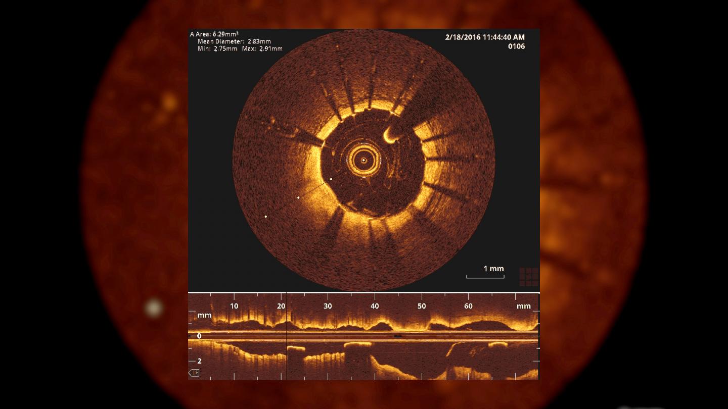 Optical Coherence Tomography