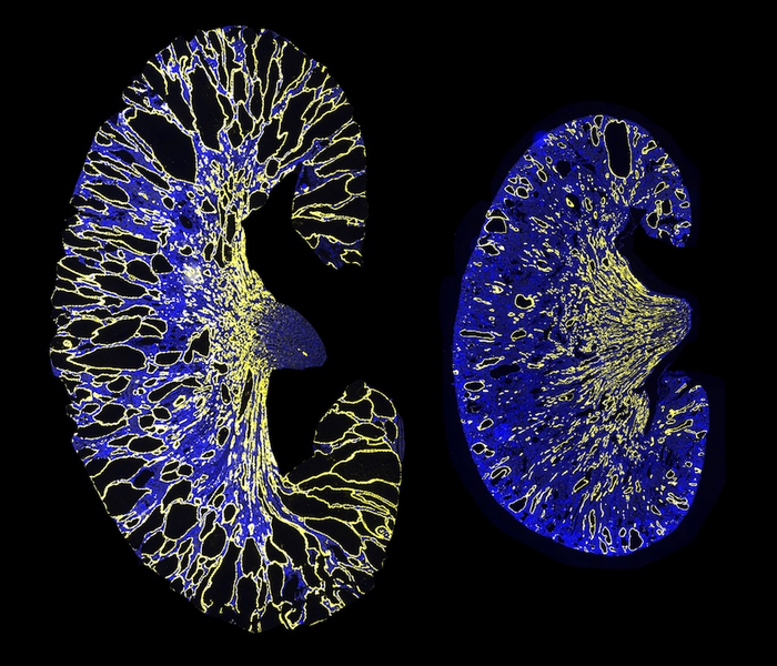 UT Southwestern researchers identify a gene therapy target for polycystic kidney disease