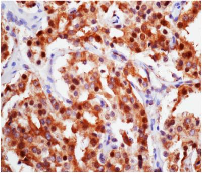 A New Route for Tackling Treatment-Resistant Prostate Cancer